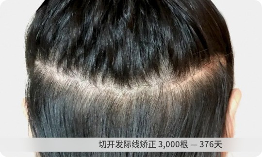 切开发际线矫正 术后1年