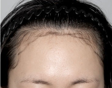 正面・长发移植手术前