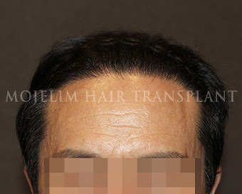 术后・60多岁・案例2
