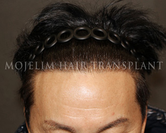 术后・60多岁・案例3