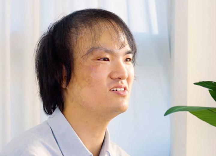毛杰琳的疤痕毛发移植