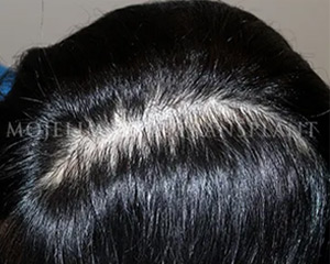 Case 1. 脑部手术后的头皮疤痕
