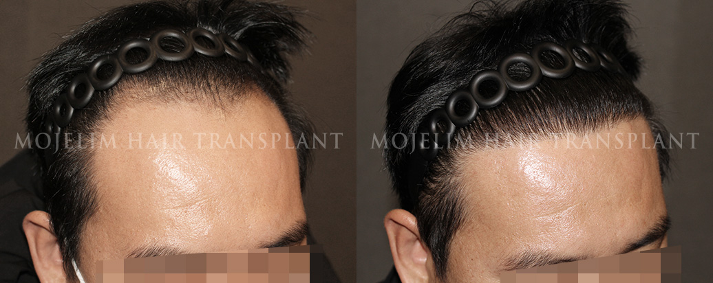 切开毛发移植 4,000根