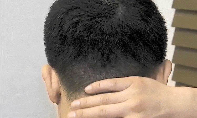 毛杰琳非切开 术后1年