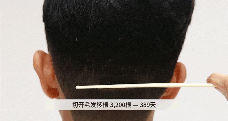 FUT手术1年后